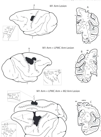 Fig. 5.Lesions of M1 arm area, M1as performed for studies of volumetric eﬀects of frontal lobe motor area lesions [ þ LPMC arm areas and M1 þ LPMC þ M2 arm areas are depicted21]