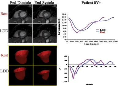 Fig. 1. Evaluation of LV volumes in a patient SV+ at rest and during LDD stress. Left upper panel: end-diastolic and end-systolic frames of a SSFP basal short axis view at baseline(rest) and during infusion of dobutamine at peak dose (LDD); left lower panel: three-dimensional reconstruction of the LV chamber in end-diastole and end-systole at rest andduring LDD at peak dose; right upper panel: representative LV volume/time curve at rest (blue) and during LDD stress (red) showing a minimal decrease in LV volumes at peakdose of dobutamine; right lower panel: representative dV/dt curve of LV at rest and during LDD stress at peak dose.