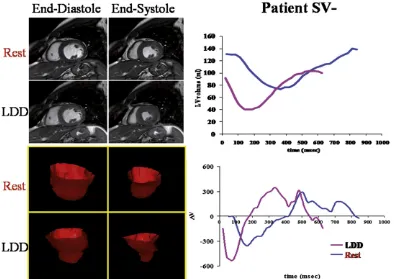 Fig. 2. Evaluation of LV volumes in a patient SV− at rest and during LDD stress. Left upper panel: end-diastolic and end-systolic frames of a SSFP basal short axis view at baseline(rest) and during infusion of dobutamine at peak dose (LDD); left lower panel: three-dimensional reconstruction of the LV chamber in end-diastole and end-systole at rest andduring LDD at peak dose; right upper panel: representative LV volume/time curve at rest (blue) and during LDD stress (red) showing a marked reduction in LV volumes at peakdose of dobutamine; right lower panel: representative dV/dt curve of LV at rest and during LDD stress at peak dose.