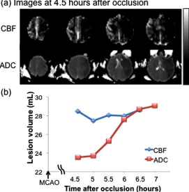 Fig. (2). A representative set of MR images from a baboon which underwent 90-min transient MCAO on the right side, including (a) MRA after reperfusion, (b) cerebral blood flow (CBF) map, (c) apparent diffusion coefficient (ADC) map, and (d) end-point T2-we