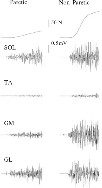 Fig. 4 Recordings of plantar ﬂexor maximum voluntary isometric(electromyogram. The end of the sample traces are 500 ms after onsetof contraction
