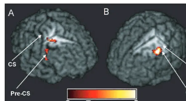 Fig. 8 fMRI results for Patients A and B shown on individual patient’s volume-rendered TPCSgreater left (affected) hand-grip activation for Patient A compared with the control group