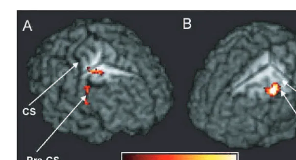 Fig. 8 fMRI results for Patients A and B shown on individual patient’s volume-rendered TPCSgreater left (affected) hand-grip activation for Patient A compared with the control group