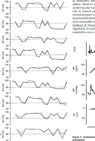 Figure 3. Instantaneous ﬂuctuations in stroke volume duringarrhythmiaPremature atrial complexes recorded in a 56-year-old subject.Decreases of as much as 50% in stroke volume occur instantaneouslyand are indicated with two non-invasive methods in near-iden