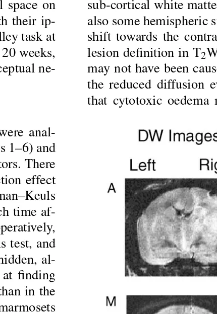 Fig. 3. Diffusion-weighted image (DWI) and apparent diffusion coefﬁcient(ADC) maps from marmosets A and O at 7.5 h after surgery and frommarmoset M 4.5 h after surgery