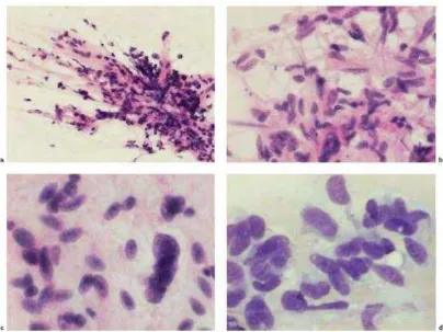Gambar 5. MPNST  a  Kelompok sel dengan kohesi longgar, moderately atypical cells dengan latar belakang matriks 