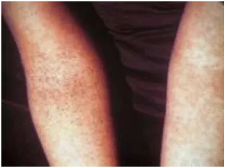 Gambar 2.2  Salah satu gejala demam berdarah adalah munculnya ruam pada kulit (http://wikipedia.org)  