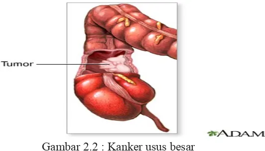 Gambar 2.2 : Kanker usus besar
