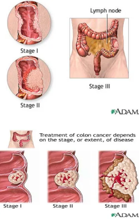 Gambar 2.3 : Penjelasan Penyakit Kanker Rektum atau Kolon