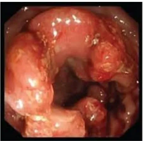 Gambar 2.4 : kanker usus besar, kolonoskopi