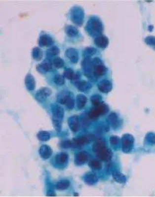 Gambar 7. Sitologi karsinoma sel besar (pewarnaan Papanicolaou).2