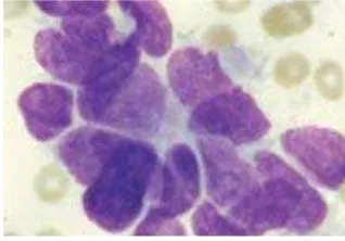 Gambar 8. Kelompok sel dengan sitoplasma yang sedikit, nuclear molding, dan 