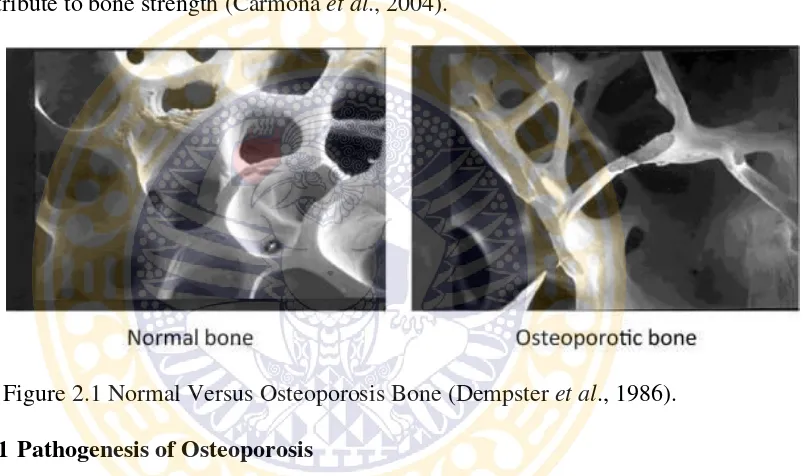 Figure 2.1 Normal Versus Osteoporosis Bone (Dempster et al., 1986). 