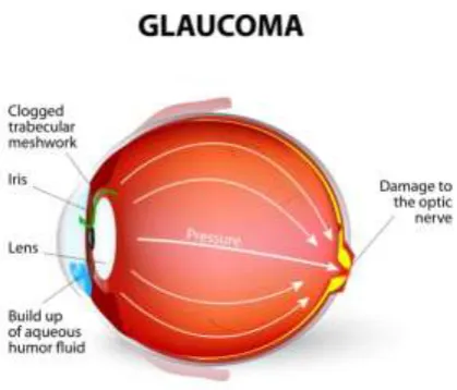 gambar mata dengan penyakit glaukoma. 