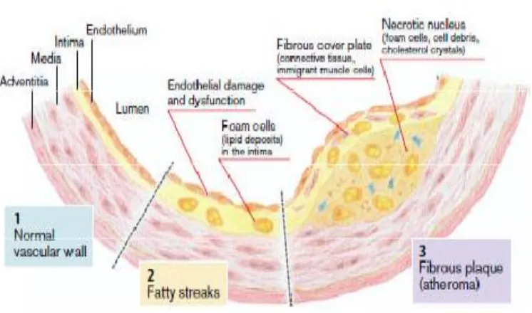 Gambar 2. Perubahan dinding vaskular pada aterosklerosis 
