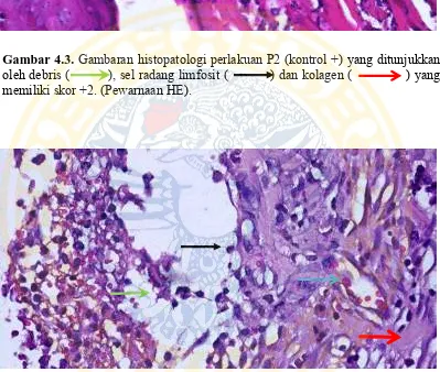 Gambar 4.4. ditunjukkan oleh debris (            ), eritrosit (            ), sel radang limfosit (             ) 