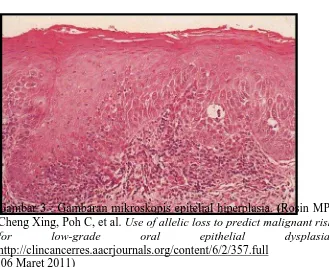 Gambar 3 : Gambaran mikroskopis epitelial hiperplasia. (Cheng Xing, Poh C, et al. for Rosin MP, Use of allelic loss to predict malignant risk low-grade oral epithelial dysplasia