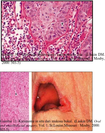 Gambar 10 : Gambaran mikroskopis karsinoma in situ.  (Laskin DM. Oral and maxillofacial surgery
