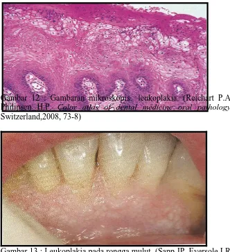 Gambar 13 : Leukoplakia pada rongga mulut. (Sapp JP, Eversole LR,  Wysocki GP. Contemporary oral and maxillofacial pathology, 2nd ed