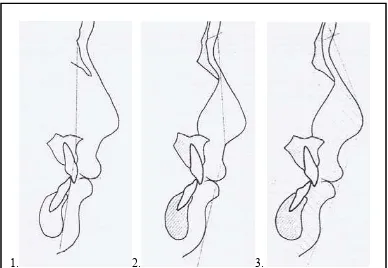 Gambar 5.   Analisa konveksitas wajah menurut Subtelny. (1) Sudut Konveksitas        wajah skeletal (N-A-Pog)