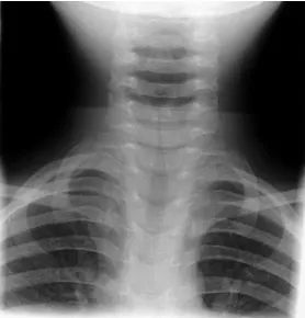 Gambar 2. Penyebaran subglotis tipis pada jalan napas pada radiografi,