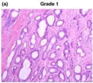 Gambar 2.2.1.1  Well-Differentiated Tumor (Grade I);  