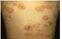 Gambar Dermatitis numularis 