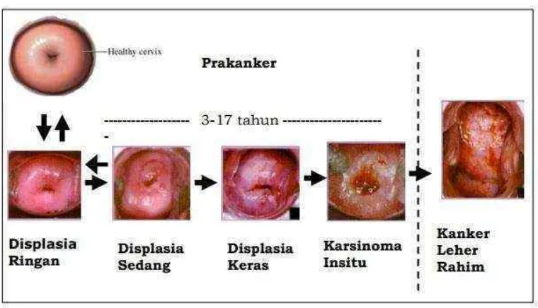 Gambar 2.2. Perjalanan Kanker Serviks (Nuranna et al., 2005 dalam Menteri Kesehatan Republik Indonesia, 2015) 