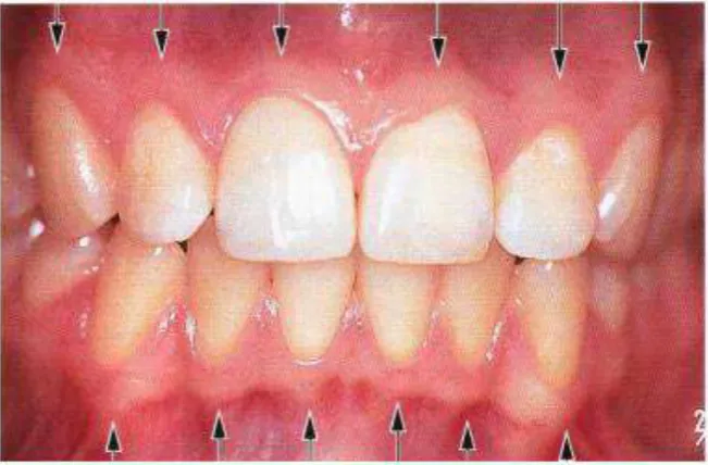 Gambar 2.1 Gingiva Normal (Carranza et al, 2012) 