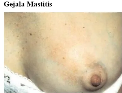 Gambar 1. Payudara Mastitis (Sumber: www.lusa.web.id) 