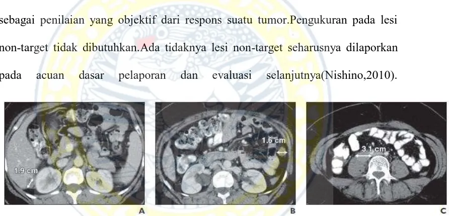 Gambar. 3 Lesi target dengan ukurannya. A-C. Ct scan abdomen, wanita, 49 tahun dengan tumor ovarium 