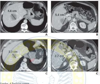 Gambar. 4 Penilaian respon A dan B, CT scan abdomen awal, laki 