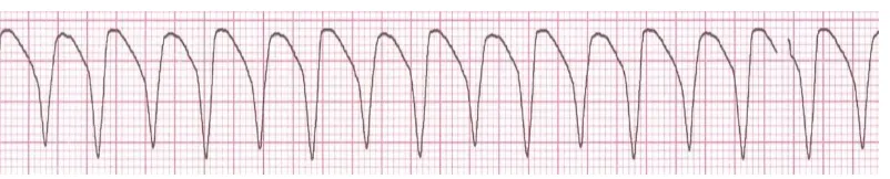 Gambar 2.1 Ritme EKG Ventricular tachicardia(Brunner et al., 2010)  
