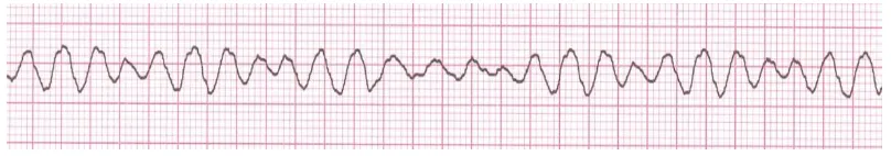 Gambar 2.2 Ritme EKG Ventricular fibrilation(Brunner et al., 2010)  