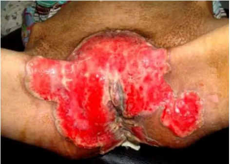 Gambar 1. Herpes genital pada seorang pasien percmpuan dengan HIV: tampak lesi berupa ulkus yang luas
