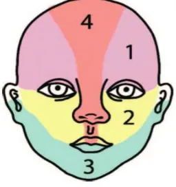 Gambar 1. Pola hemangioma segmental pada wajah: (1) 