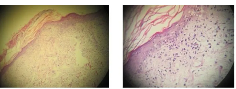 Gambar 3.   vakuolar sel basal dan sunburn cells. Dermis tampak dropping melanin, sebukan sel radang dominasi limfositHasil pemerksaan histopatologi