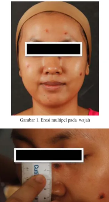 Gambar 1. Erosi multipel pada  wajah 