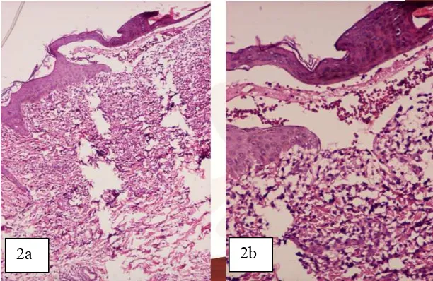 Gambar 1a dan b.Gambaran klinis menunjukkan bula tegang multipel dalam berbagai ukuran di atas kulit  normal atau patch hiperpigmentasi.Permukaan kulit teraba kasar dengan plak dan nodus eritema multipel serta skar hipertrofi