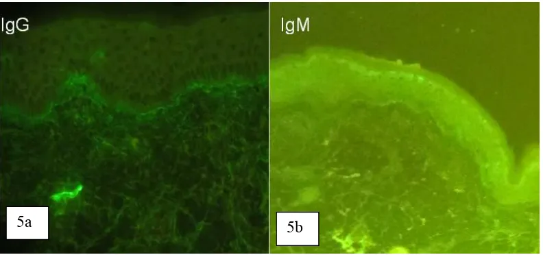 Gambar 5a & b. Pemeriksaan imunofluoresensi langsung menunjukkan deposit IgG dan IgM linear di membran basalis