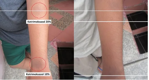 Gambar 4. Repeated open application test pada lesi kulit residual. Kiri: hari ke-0; kanan: hari ke-14