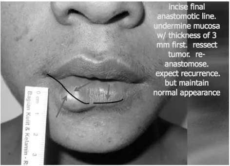 Gambar 10. Desain “subterranean dissection” untuk lesineurofibroma di bibir bawah kanan.
