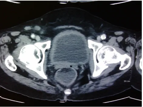 Figure 4: CT abdomen showing bladder wall thickening 