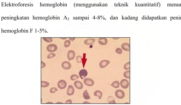 Gambar 2.3 Basofil Stippling  pada penderita thalassemia beta minor16 