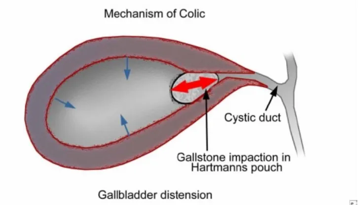 Gambar 1.1 Sumbatan batu empedu yang menyebabkan nyeri kolik bilier (Gilroy,2009).