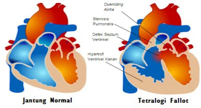 Gambar 1. Jantung normal dan jantung TOF