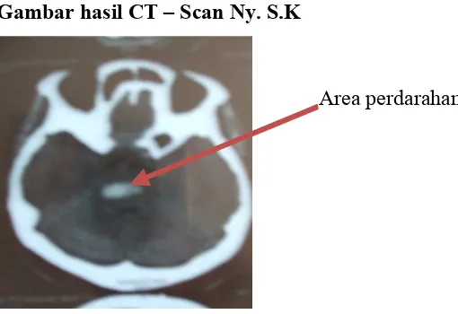Gambar hasil CT – Scan Ny. S.K