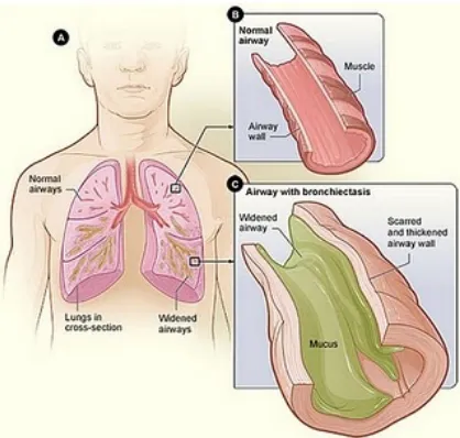 Gambar jalan nafas yang terkena mucus akibat bronchiectasis
