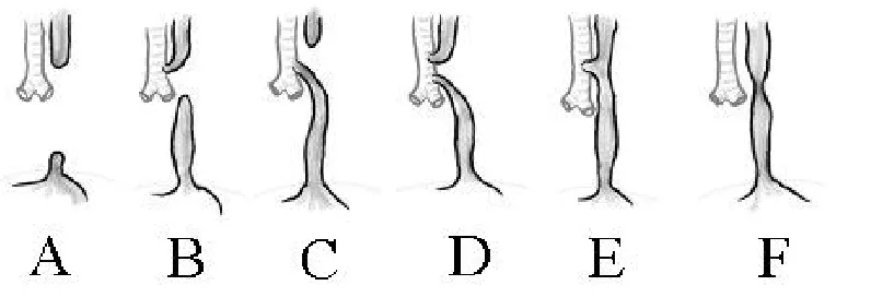 Gambar 2.1 Variasi Atresia Esofagus 