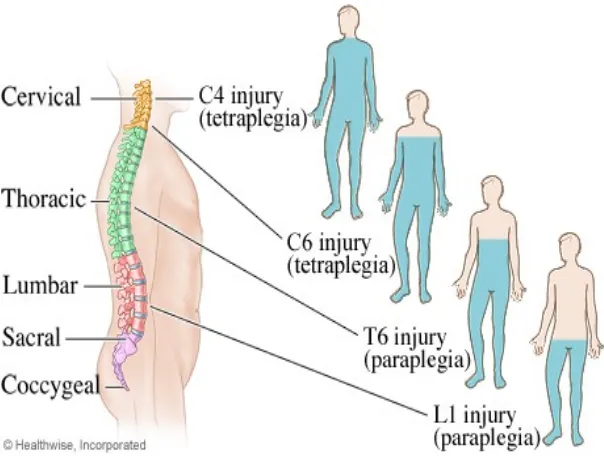 Gambar. Klasifikasi Trauma Medula Spinalis